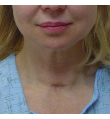 platysma bands